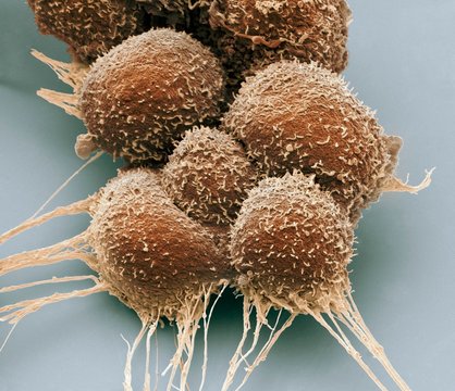 Close up of prostate cancer cells