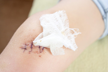 Obraz na płótnie Canvas Cut wound on human leg with four sutures superimposed and a piece of bandage on it close up