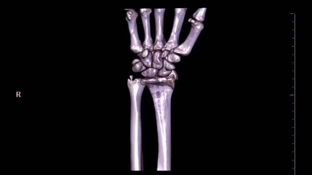 CT scan of Left wrist joint  3D rendering image rotating on black background .Fracture ulnar bone. medical technology concept.