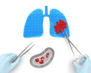 Lungs cancer operation oncotomy puzzle concept: hands of surgeon with surgical instruments (tools) performs surgery to remove cancerous growth (malignant swelling or benign tumor)