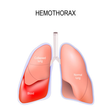 Hemothorax
