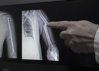 Xray of fracture of a hand and hand after operation