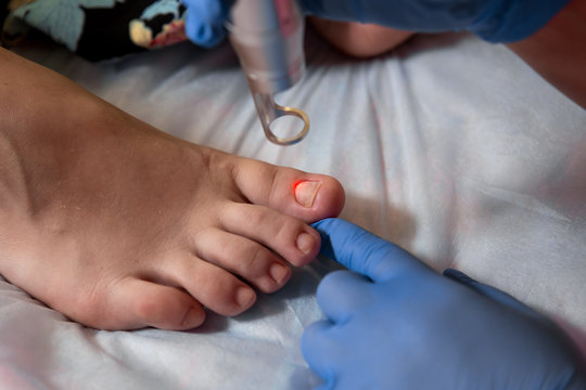 Podology Treatment. Podiatrist Treating Toenail Fungus. Doctor Removes Calluses, Corns And Treats Ingrown Nail. Hardware Manicure. Health, Body Care Concept. Selective Focus.