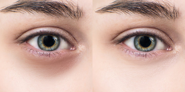 Female eyes with bruises under eyes before and after treatment.