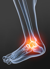 Osteoarthritis, painful ankle joint, 3D illustration