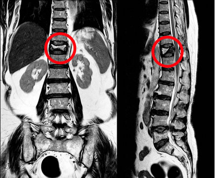 MRI Thoracic lumbar spine show moderate pathological compression fracture of T12 level.