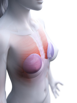 3d rendered medically accurate illustration of a womans breast implants