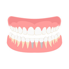 Obraz premium Dental implantation. Healthy human teeth and Dental implant. dental implant. Vector illustration