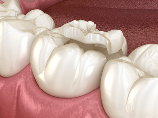Inlay ceramic crown fixation over tooth. Medically accurate 3D illustration of human teeth treatment