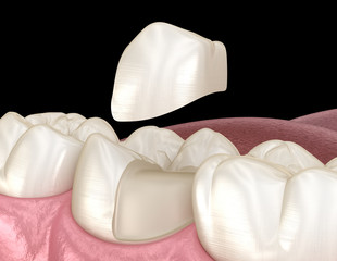 Fototapeta na wymiar Onlay ceramic crown fixation over tooth. Medically accurate 3D illustration of human teeth treatment