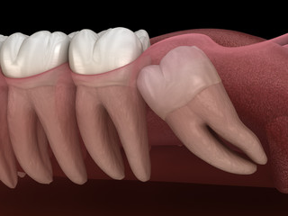 Healthy teeth and wisdom tooth with mesial impaction . Medically accurate tooth 3D illustration