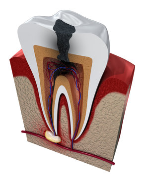 Tooth decay. Medically accurate tooth 3D illustration