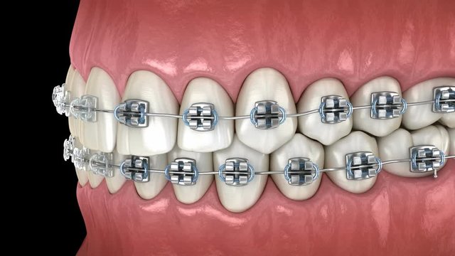 Teeth with metal and Clear braces in gums. Medically accurate dental 3D animation