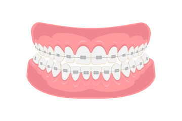 Teeth with braces on white background. Alignment of bite of teeth, correct bite of teeth. Dental jaw with braces, Dental braces. Vector illustration.