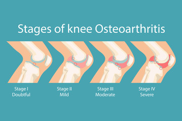 Stages of knee Osteoarthritis. Human Knee Osteoarthritis infographics. Vector illustration. 
