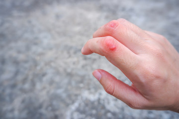 Close up hands of the woman with scar. Beauty skin healthcare concept.