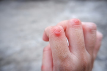Close up keloid scar on fingers of the woman. Can use for skin imperfections concepts.