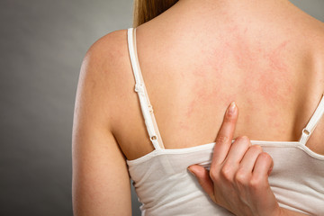 woman scratching her itchy back with allergy rash - obrazy, fototapety, plakaty