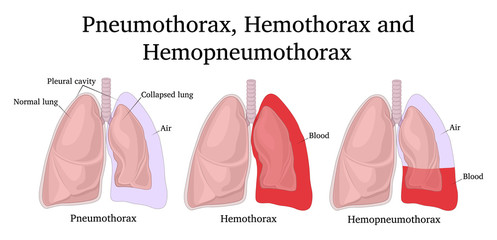 Illustration of Pneumothorax, Hemothorax and Hemopneumothorax