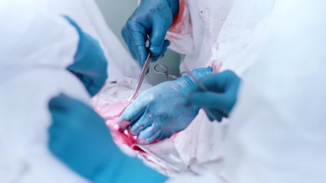 Hands of professional surgeons performing operation to remove cancerous tumor in abdominal cavity