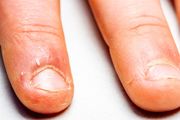 Close up of hand with bitten finger and fingernails.