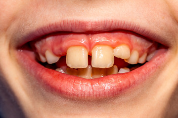 Close-up of child of eight years with the problem of not loosing his baby teeth 10 month after treatment - persistent baby teeth, also called shark disease - after surgery removing of milk teeth