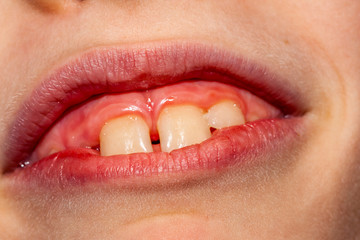 Fototapeta premium Close-up of child of eight years with the problem of not loosing his baby teeth 10 month after treatment - persistent baby teeth, also called shark disease - after surgery removing of milk teeth