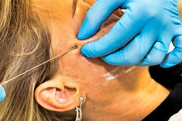Dermatologist performs anti-age procedure using PDO thread on middle-aged woman patient - selective focus
