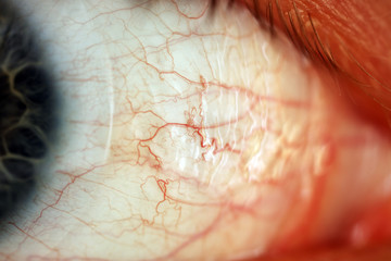 Blue Eye and Blood Vessels