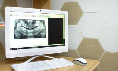 x-ray in dentistry snapshot of a tooth. computer monitor