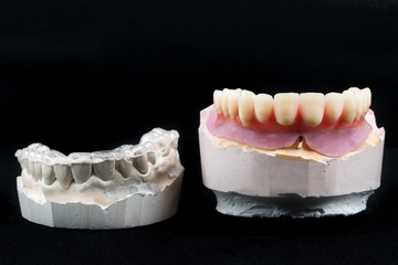 special to Kappa Dental model and ceramic prosthesis on a black background