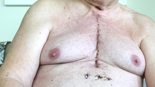 Scar from open heart surgery, where the sternum was cut in two, and the rib cage sprung. Below the scar holes show where the drains and pacemaker cables emerged. Image taken 12 days following surgery