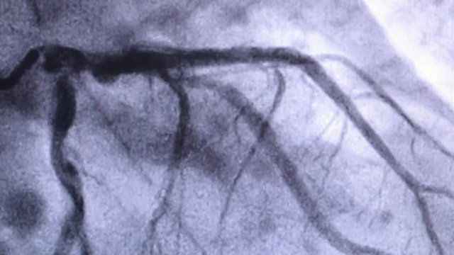 Catheterization. Cardiac ventriculography is a medical imaging test used to determine a patient cardiac function in the right or left ventricle