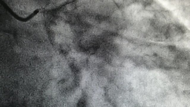Catheterization. Cardiac ventriculography is a medical imaging test used to determine a patient cardiac function in the right or left ventricle