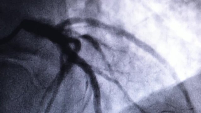 Catheterization. Cardiac ventriculography is a medical imaging test used to determine a patient cardiac function in the right or left ventricle