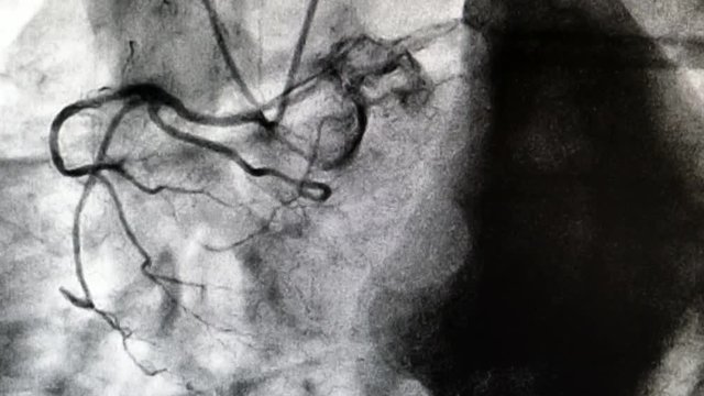 Catheterization. Cardiac ventriculography is a medical imaging test used to determine a patient cardiac function in the right or left ventricle