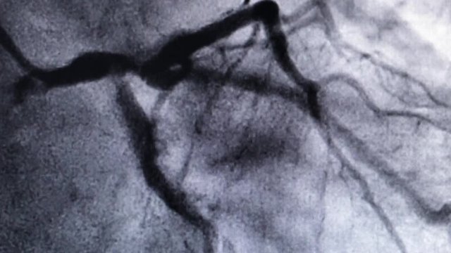 Catheterization. Cardiac ventriculography is a medical imaging test used to determine a patient cardiac function in the right or left ventricle