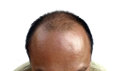 A broad forehead, balding and thinning hair.
