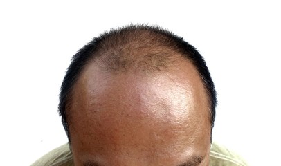 Fototapeta premium A broad forehead, balding and thinning hair.