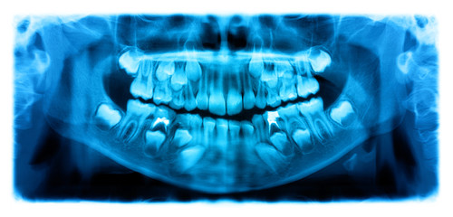Panoramic radiograph is a scanning dental X-ray of the upper jaw maxilla and lower jawbone mandible a child aged 7 seven years. © feelisgood