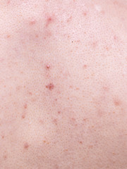 Closeup human skin with problem