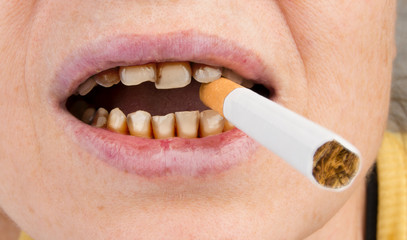 a woman holds a cigarette in her mouth with bad teeth. Concept of smoking harmful effect. © denklim
