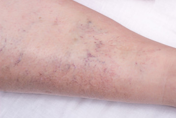 Vascular marks on the skin from varicose veins, vascular pattern on the skin, close-up, phlebeurysm, problem, white background, medical