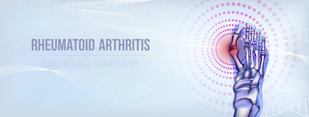 Rheumatoid arthritis bones concept