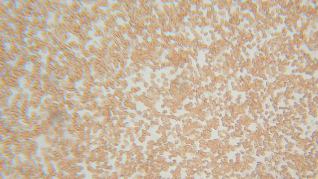 Blood, diseases, interstitial fluid, bacterial background, research using a microscope at extreme magnification of about...