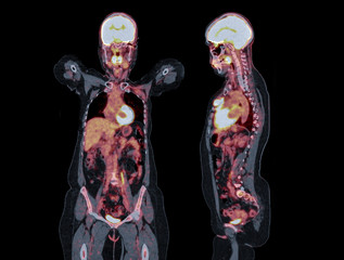 PET CT image of Whole human body coronal and sagittal plane. Positron Emission Tomography Computed...