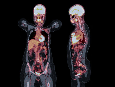 PET CT image of Whole human body coronal and sagittal plane. Positron Emission Tomography Computed Tomography .
