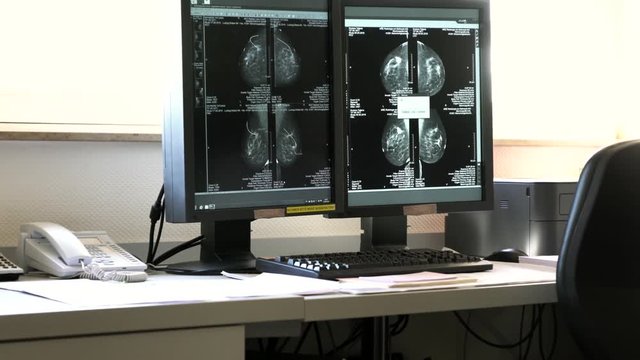 Medical monitor with the results of patient famale breast cancer research