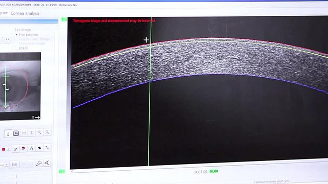  ophthalmological examination of the cornea of the eye on the screen of the monitor, cornea of the eye on the screen of the monitor