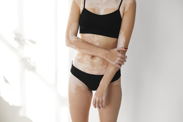 Cropped shot of unrecognizable female wearing black top and panties having vitiligo disease, posing at white wall. Studio portrait of female in underwear suffering from auto immune skin disorder